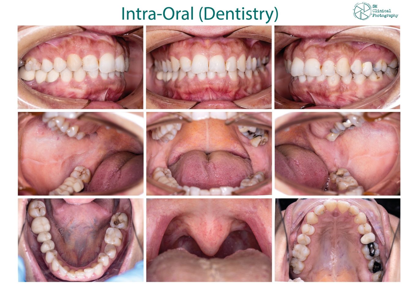 Collage of intra-oral dental images showing various tooth and gum conditions.